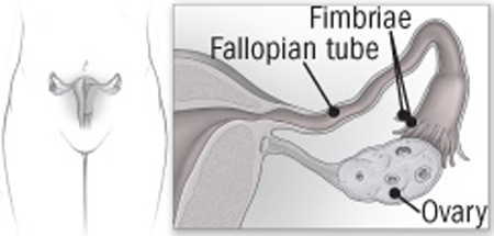 fallopian tubes - where ovarain cancer starts